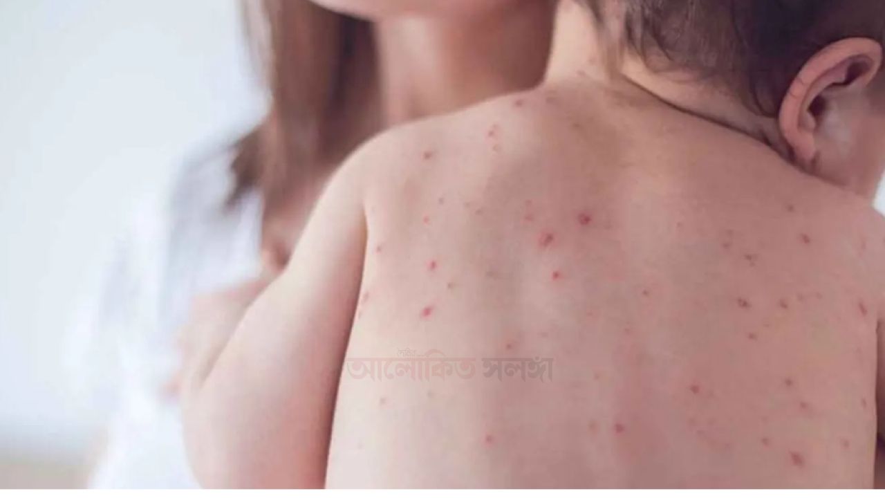 হামের উপসর্গে আরও ৭ শিশুর মৃত্যু।