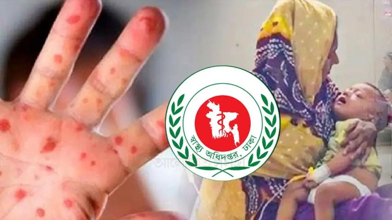 হাম ও উপসর্গে মৃত্যু ৬০০ ছাড়াল।