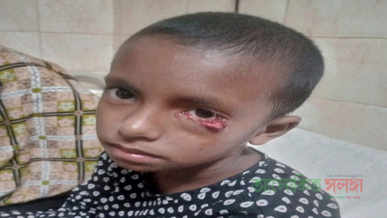 রংপুরে বেওয়ারিশ কুকুরের কাঁমড়ে আহত ১২  রিয়াজুল হক সাগর, রংপুর। রংপুর সিটির ৮নং ওয়ার্ডের বিভিন্ন গ্রামে ও পাড়ায় কুকুরের উৎপাত বেড়ে যাওয়ায় জনমনে আতংক সৃষ্টি হয়েছে!   ২৯ অক্টোবর ২০২৬   রংপুর সিটি কর্পোরেশনের ০৮ নং ওয়ার্ডের চাঁদকুঠি তেলীটারী সৎবাজার এলাকায়, ও আঠারোদোন এলাকার মিল্টন মিয়ার স্ত্রী, বধুকমলা এলাকার বেশ কয়েকজনকে  একটি বেওয়ারিশ কুকুর  শিশু ও নব দম্পতিসহ ১২ জনকে কামড়িয়ে আহত করার সংবাদ পাওয়া গেছে। আহত ৩ জন শিশু বর্তমানে রংপুর মেডিকেল কলেজ হাসপাতালে ভর্তি আছে।বাকিদের প্রাথমিক চিকিৎসা দেয়া হয়েছে। কুকুরটি এখনও এলাকায় দাঁপিয়ে বেড়াচ্ছে  এতে এলাকায় ভীতিকর পরিবেশ সৃষ্টি হয়েছে। এই এলাকার সাধারণ মানুষের মধ্যে আতংকও বিরাজ করছে। রাতের আধাঁরে বিভিন্ন জায়গায় কুকুরের উৎপাত বেড়ে যাওয়ায়। বিশেষ করে ফজরের নামাজের সময়, নামাজ পড়তে যাওয়া মুসল্লিদের আক্রমণ করার চেষ্ট করে।এতে এলাকার মানুষদের মধ্যে ভয় ও আতংক তৈরী হয়েছে। এলাকাবাসীর দাবি মাননীয় রংপুর সিটির প্রসাশক যাতে করে এই বিষয়টি দ্রুত সমাধান করার চেষ্ট করেন। এলাকাবাসীকে সাবধানে চলাচলের বিষয়ে সাবধানতা অবলম্বন করতে হবে। রংপুর সিটি কর্পোরেশন ও প্রাণিসম্পদ অধিদপ্তরের জরুরী হস্তক্ষেপ কামনা করছেন এলাকবাসী।